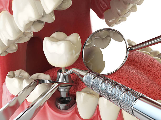 Best Lost Filling or Crown Replacement in Stacy, MN